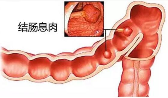 清除肠道“肉疙瘩”，防癌行动领先一步！