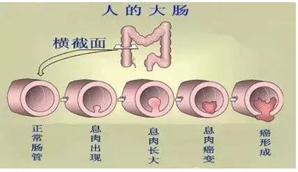 结肠息肉有什么危害？