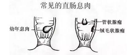 结肠息肉有什么危害？