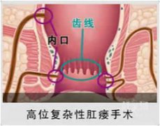 治疗肛瘘，信赖福州医博肛肠医院