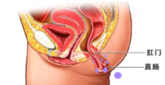 福州治疗直肠息肉哪种方法不错?