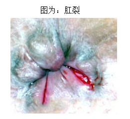 福州女性肛裂怎么治?