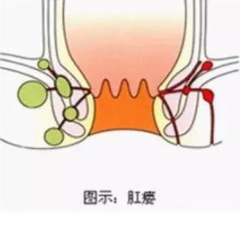 福州治肛瘘好的医院是哪家?